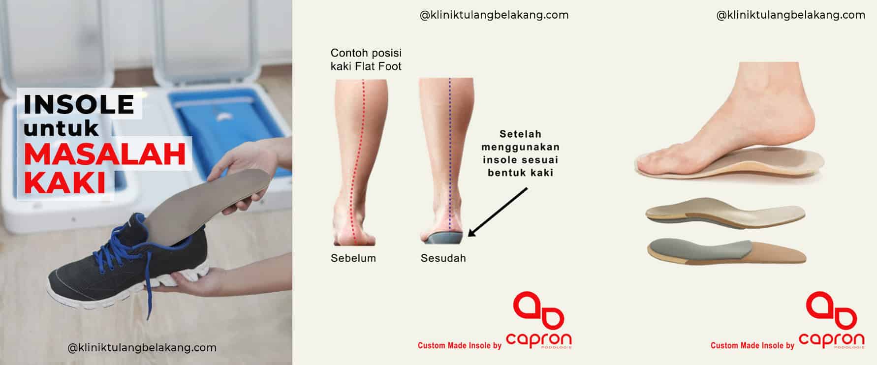 Insole dan Masalah Kaki 1