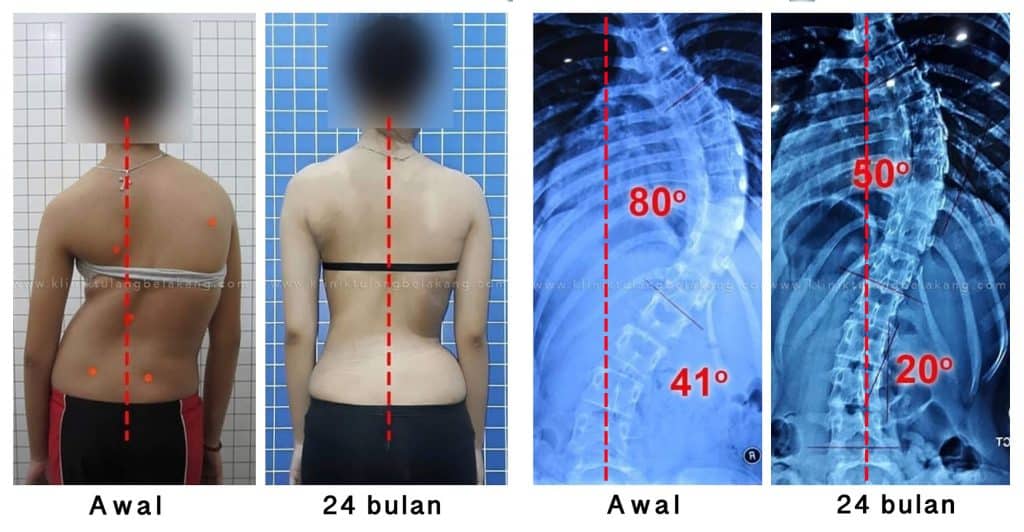 Kurva Hasil Senam untuk Skoliosis