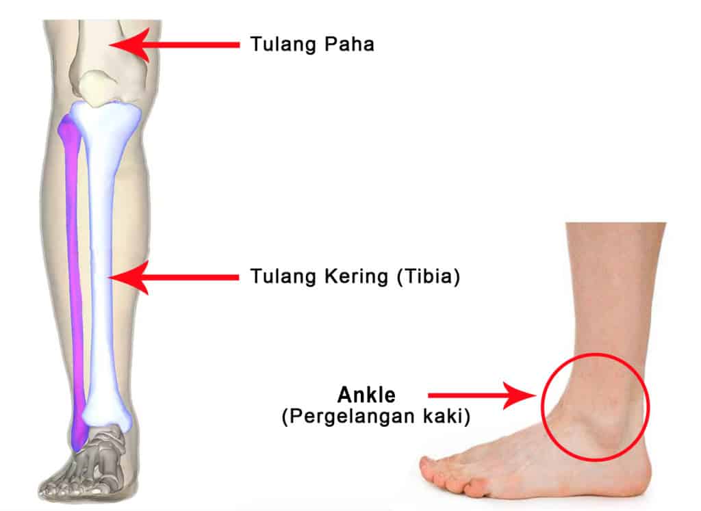 kelainan tulang kaki