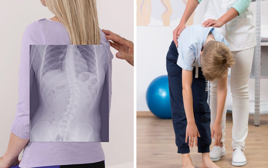 Deteksi Dini Skoliosis pada Anak