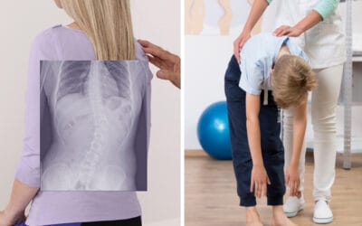 Deteksi Dini Skoliosis pada Anak