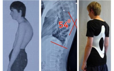 Apa itu Scheuermann Disease atau Juvenile kyphosis?