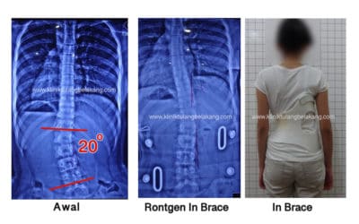 Koreksi Sempurna Skoliosis Tulang Lumbar dengan Brace 3D GBW