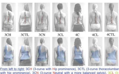 7 Jenis Skoliosis yang Perlu Anda Ketahui
