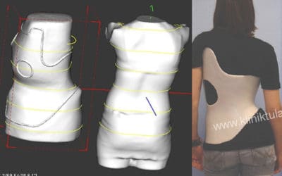 Kenapa Brace GBW (Gensingen Brace Weiss)?