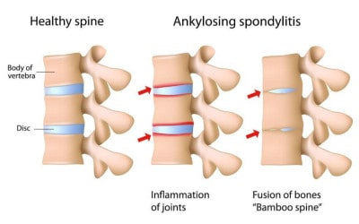 Gangguan tulang belakang Bamboo Spine atau Ankylosing Spondylitis
