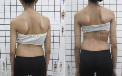 Perbaikan Postur tubuh pada Skoliosis Berat