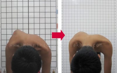 Scoliosis Anda dapat dikoreksi dengan Brace GBW