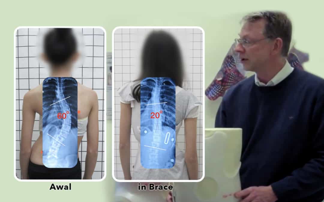 Kenapa Brace Scoliosis GBW berhasil dan brace lainnya tidak seberapa?