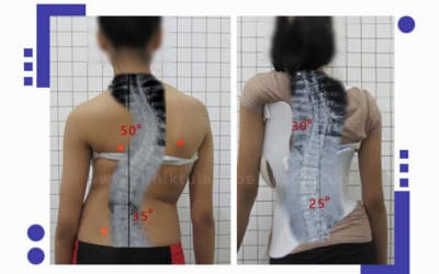 Skoliosis bisa sembuh dengan pemakaian konsisten Brace GBW