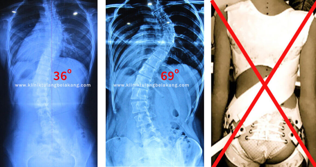 Bukti Brace GBW merupakan Solusi bagi Pasien Scoliosis