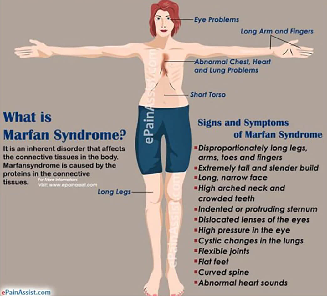 Skoliosis dan Kelainan Sindroma Marfan yang Perlu Anda Ketahui