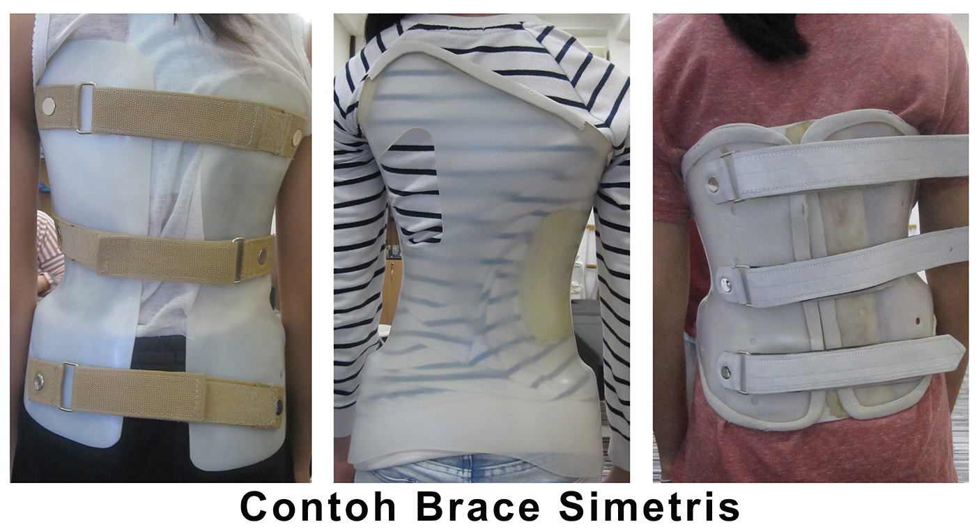7 Perbedaan Brace Scoliosis GBW dan Brace simetris