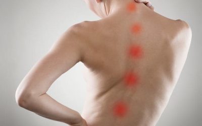Pengaruh Vitamin D3 Pada Skoliosis