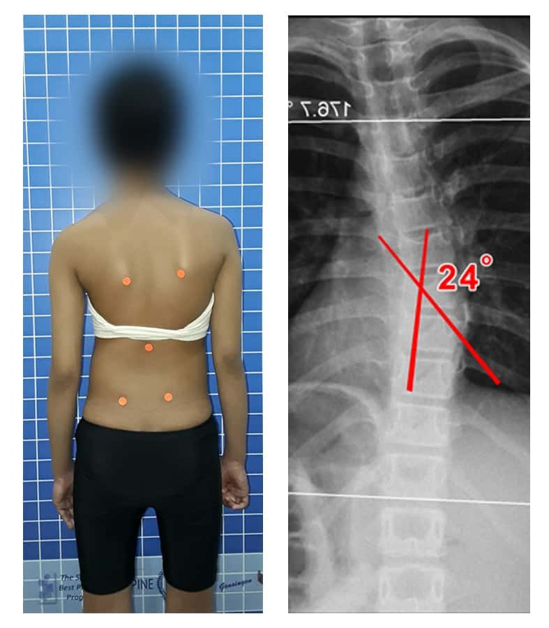 Menunda Pengobatan Skoliosis di Waktu Puber Berbahaya?
