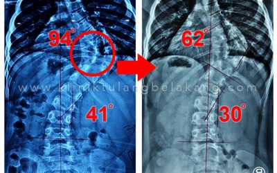 Penyebab, Gejala, dan Solusi Terkini untuk Skoliosis Kongenital.