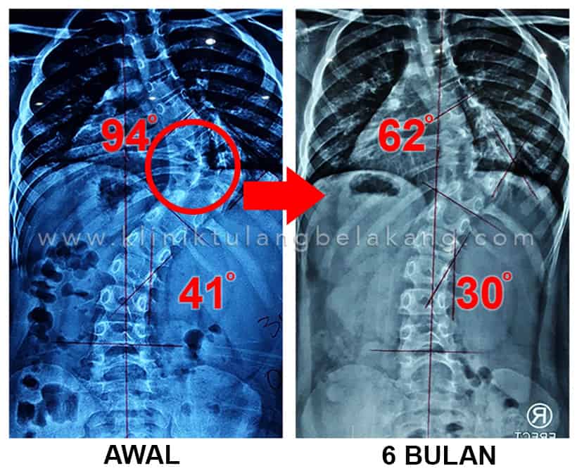 Penyebab, Gejala, dan Solusi Terkini untuk Skoliosis Kongenital.