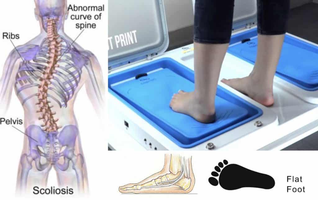 PERMASALAHAN KAKI  DATAR  FLAT FOOT DAPAT MEMPENGARUHI 