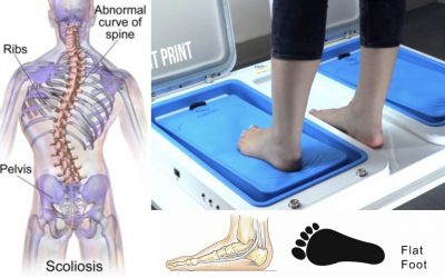 PENYAKIT FLAT FOOT, PENYEBAB, GEJALA DAN PENGOBATAN YANG EFEKTIF