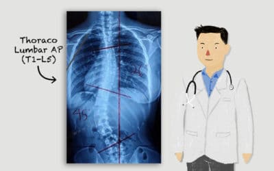 Pentingnya Rontgen Tulang Belakang Untuk Pemeriksaan Skoliosis – Ini 3 Tujuannya!