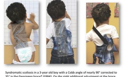 Skoliosis pada Anak: Penyebab, Gejala, dan Strategi Pengelolaan yang Efektif