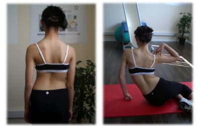 Scoliosis… Operasi, terapi rehabilitasi atau brace?