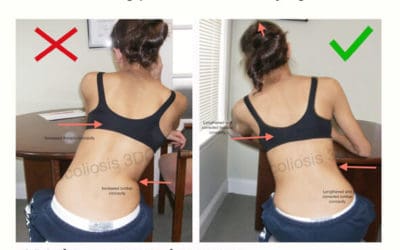 Tips Posisi Duduk Skoliosis yang Nyaman Untuk Aktivitas Sehari-hari