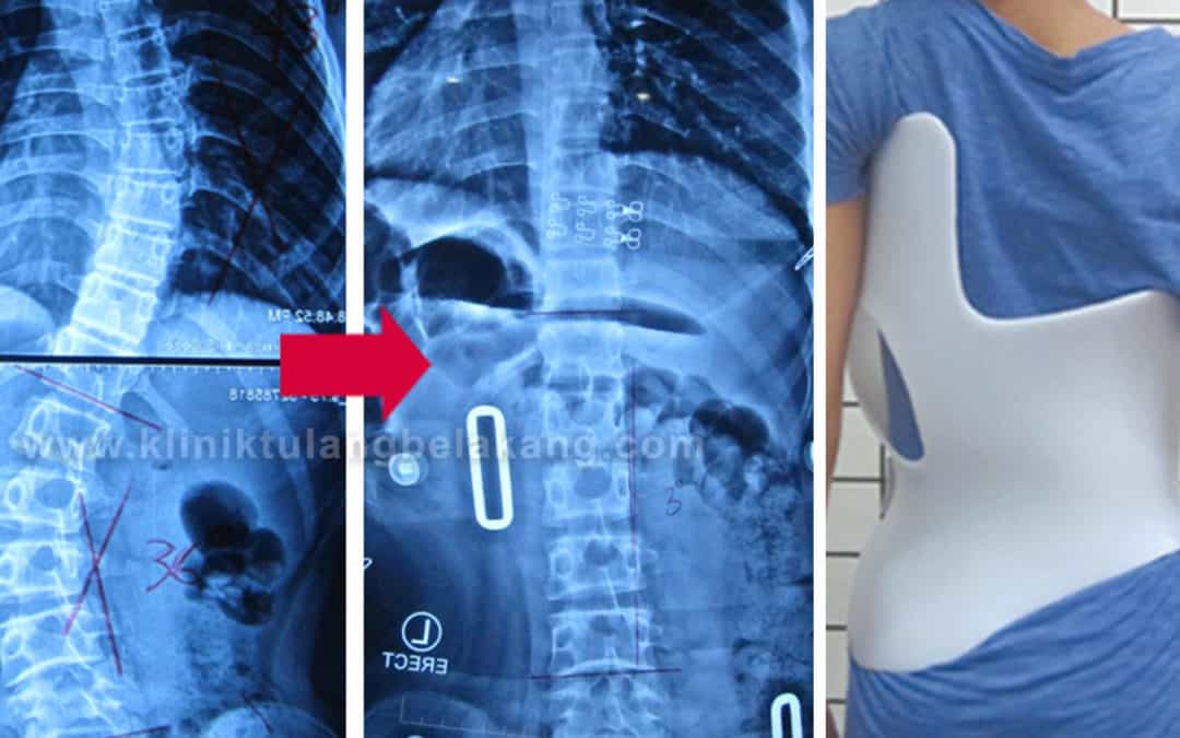 Brace GBW mampu mengkoreksi lengkungan dan rotasi Scoliosis