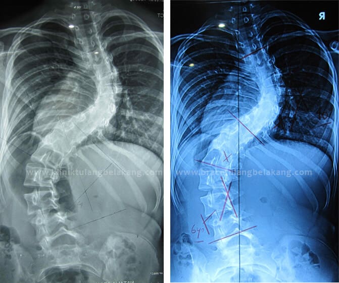 (Foto Rontgen sebelum dan sesudah 6 bulan, tampak bagian atas berkurang signifikan dan tulang lebih sejajar)