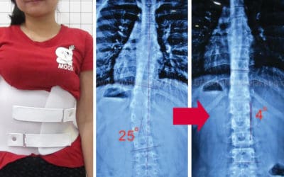 Mau Brace yang Bagus untuk Skoliosis? Simak Dulu Ulasan Ini!