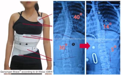 Pemakaian Brace Scoliosis yang tepat akan menghindarkan dari Operasi