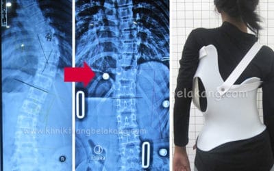 5 Alasan Kenapa Skoliosis harus diobati