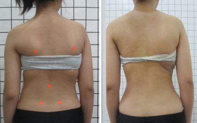 Cerita penderita Skoliosis yang optimis, gigih dan pantang menyerah!