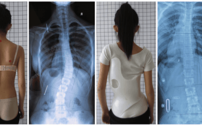 Gensingen German Brace 3D CAD/CAM Skoliosis: Teknologi Terbaik Terkini