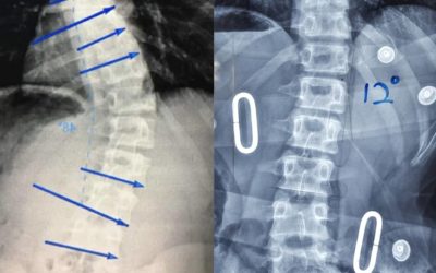 Koreksi 75% pada Pasien Skoliosis dengan brace GBW di Malaysia