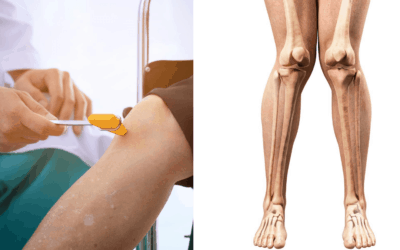 Penyebab Kaki X dan Pengobatan yang Tepat