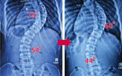 Inilah Cara Terapi Mengobati Skoliosis Lebih Dari 50 Derajat