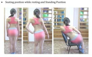 terapi scoliosis non operasi