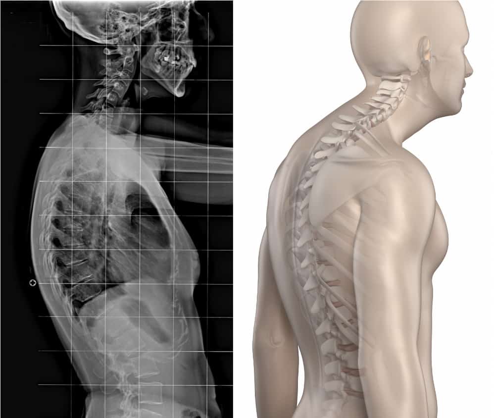 Kelainan pada tulang belakang yang dapat mengakibatkan tubuh menjadi bungkuk yaitu