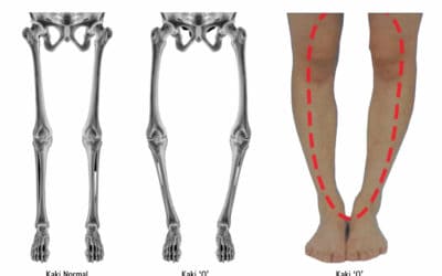 Penyebab Kaki O atau Bowlegs dan Treatment yang Tepat