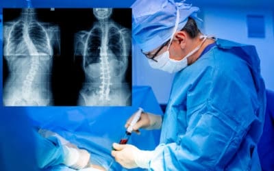 Efek Samping Pasca Operasi Skoliosis Dan 4 Bahayanya!