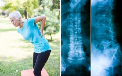 Penyebab Terjadinya Spondylolisthesis