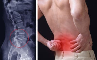 Spondylolisthesis (Sakit Pinggang) Dapat Menyebabkan Kelumpuhan? Kenali 5 Bahayanya!