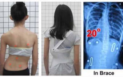Terapi Skoliosis dengan Brace: Golden Time (Masa Keemasan)