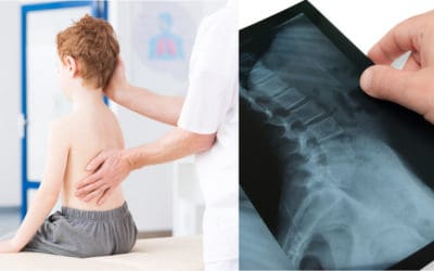 Berbagai Penyebab Tortikolis dan Penyebabnya