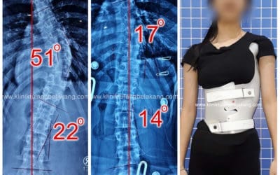 Apakah Skoliosis lebih dari 50 derajat masih bisa diobati?