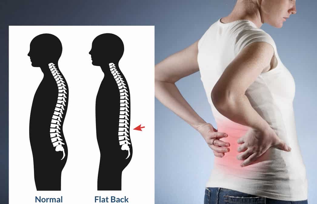 Bagaimana Efek Postur Flatback dan Terapinya?
