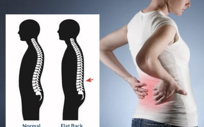 Bagaimana Efek Postur Flatback dan Terapinya?