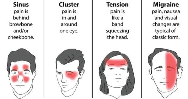 4 jenis sakit kepala yang paling umum
