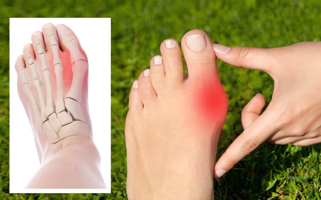 Bunion: Benjolan pada Jempol Kaki Dan 5 Penyebabnya